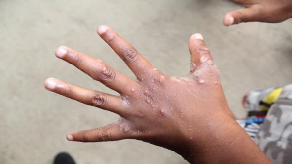 Scabies Causes Rheumatic Heart Disease FBC News